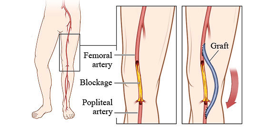 Peripheral Arterial Surgery